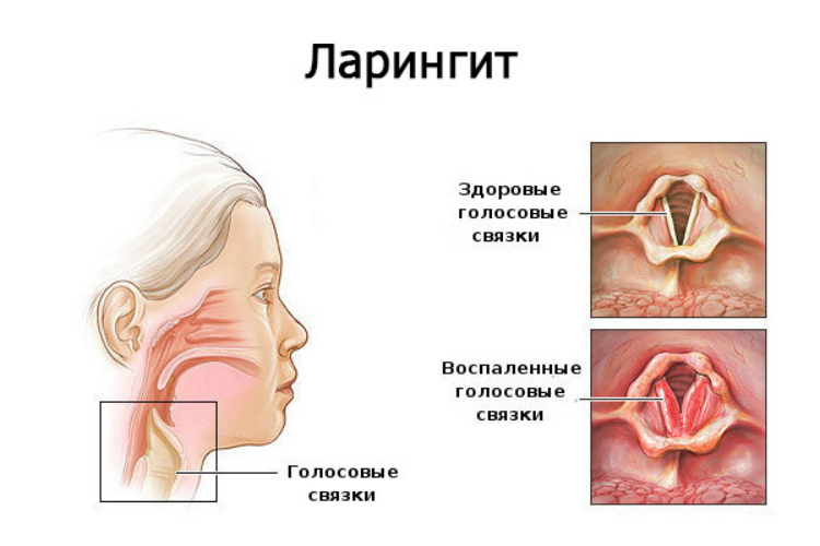 Ларингит. Лечение в Харькове