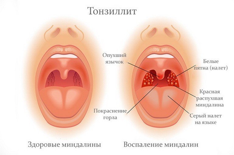 Тонзиллит. Лечение в Харькове