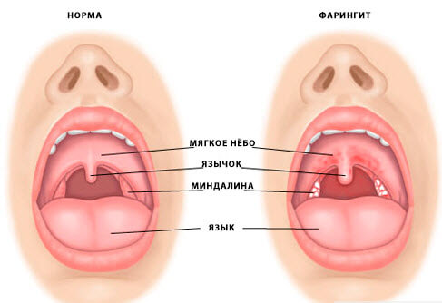 Фарингит. Лечение в Харькове