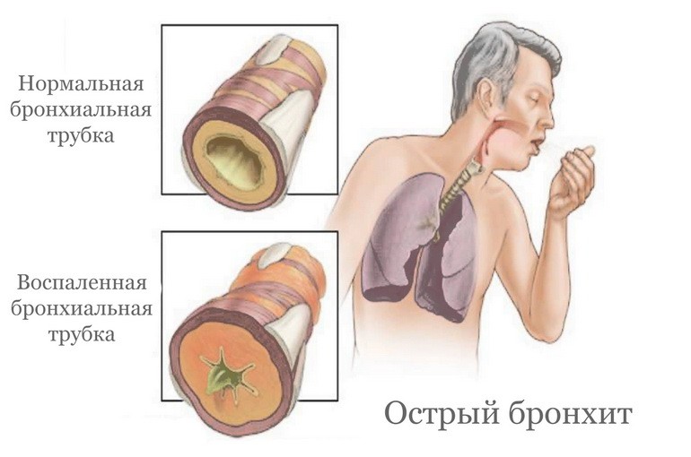 Лечение бронхита в ЦМЭИ