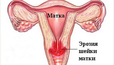 Лечение эрозии шейки матки