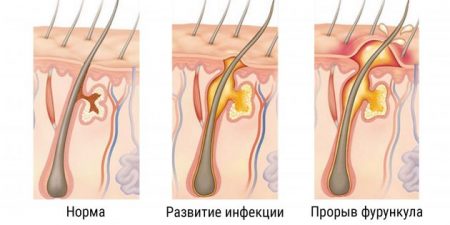 Появился фурункул. Что делать?