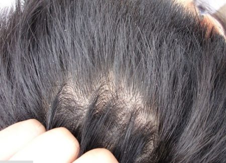Псориаз волосистой части головы. Что это? Как лечить?